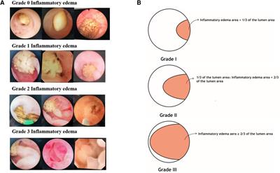 Ureteral inflammatory edema grading clinical application